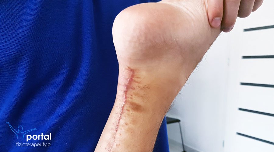 Leczenie blizn w sposób kompleksowy