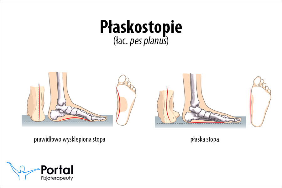 płaskostopie