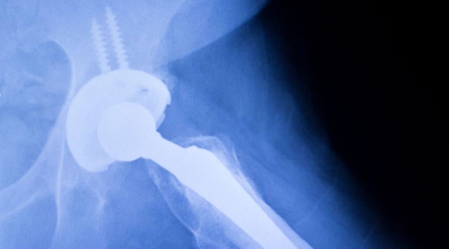 Endoprotezoplastyka stawu biodrowego