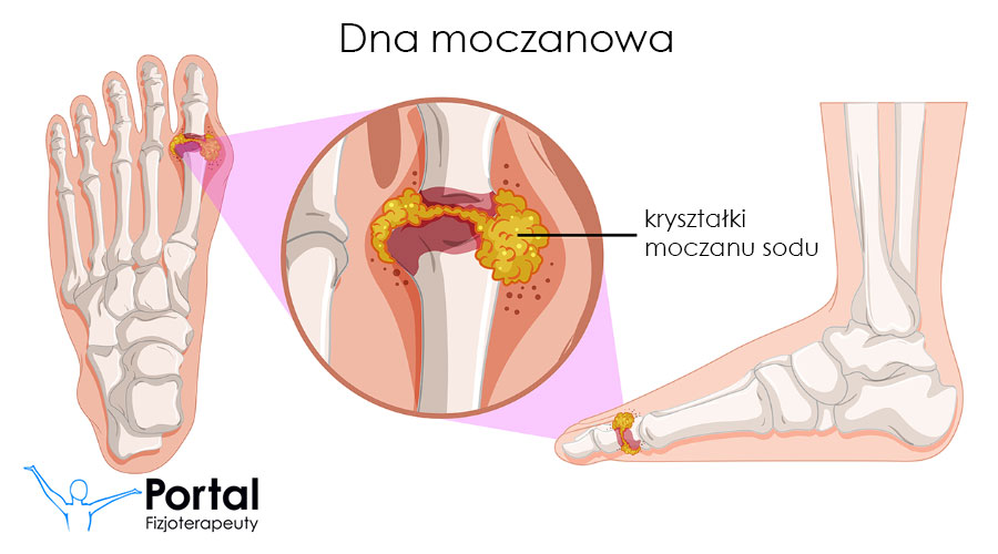 Dna moczanowa