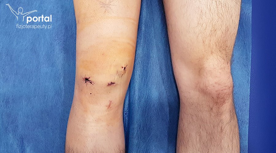 Uszkodzenie więzadła krzyżowego przedniego