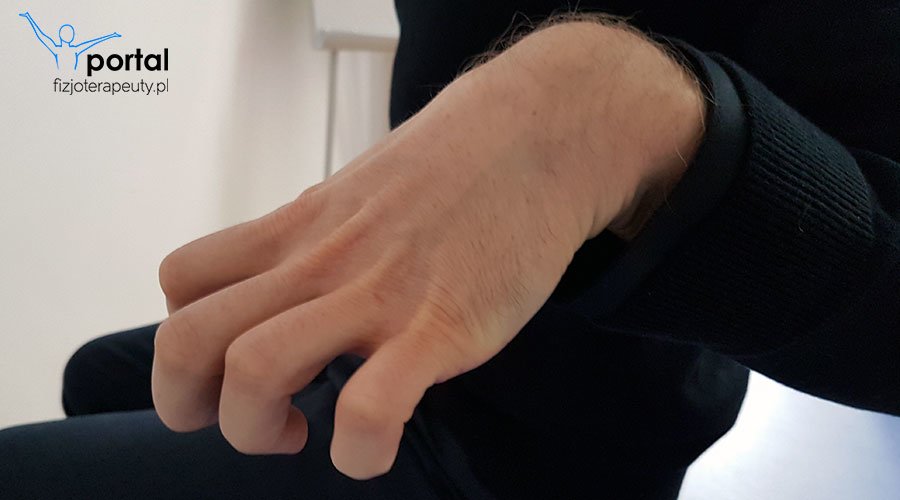 Zespół Volkmanna - przyczyny, objawy, leczenie