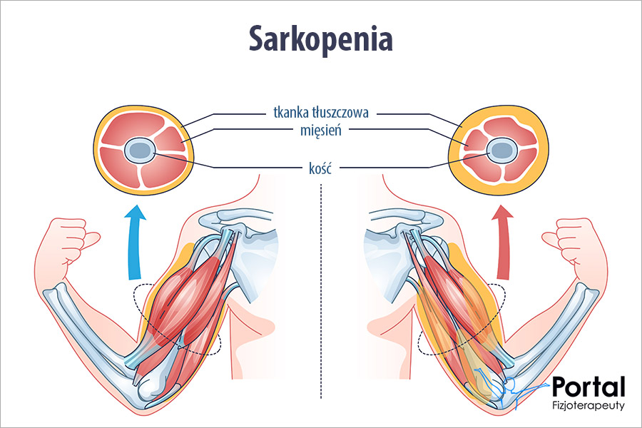 Sarkopenia