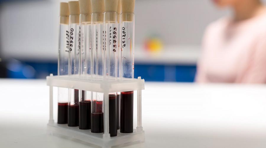 Hemofilia - rodzaje, objawy, leczenie