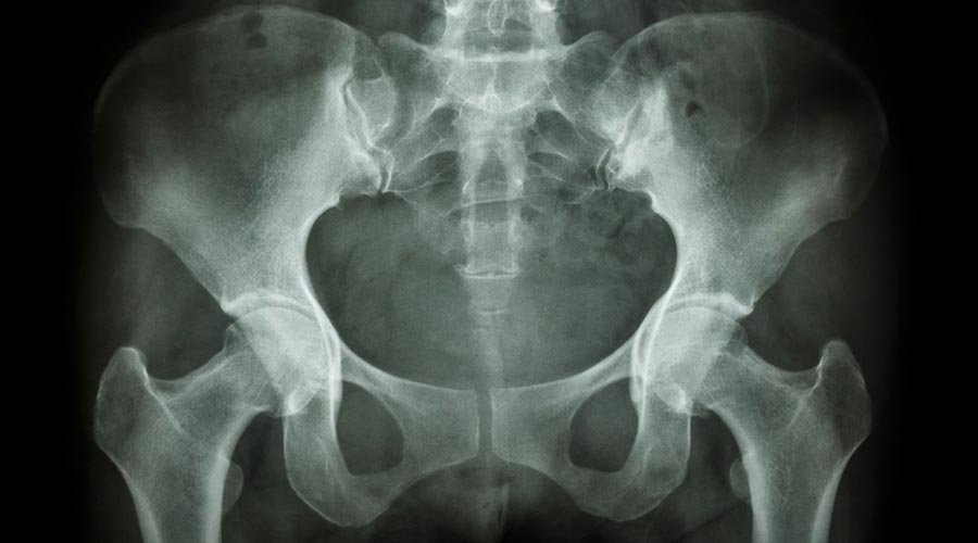 Złamania w obrębie miednicy