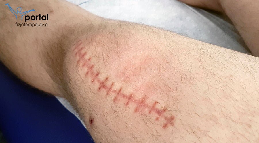 Uszkodzenia skóry - fizjoterapia