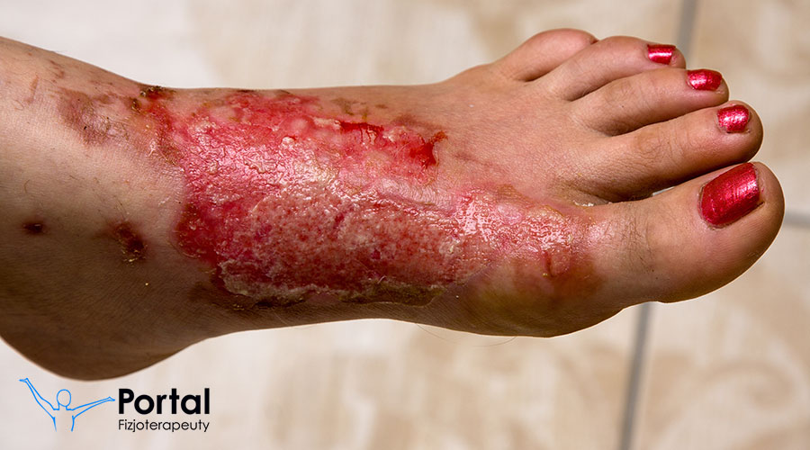 Oparzenia - stopnie, fizjoterapia