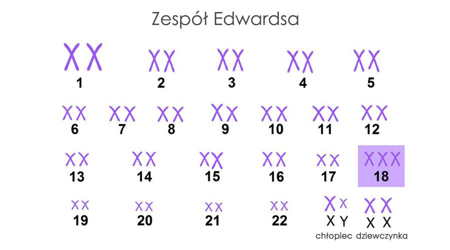 Zespół Edwardsa
