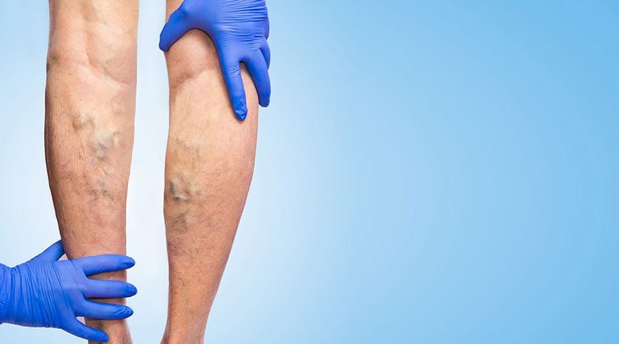 Przewlekłe niedokrwienie kończyn dolnych