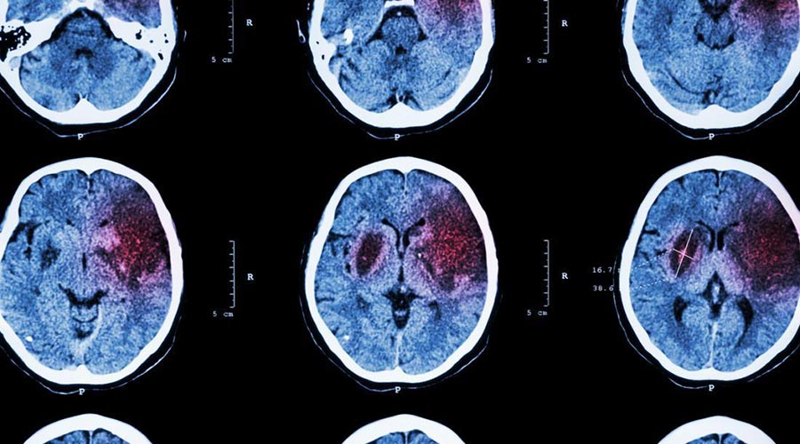 Rehabilitacja po udarze mózgu