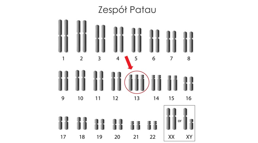 Zespół Patau