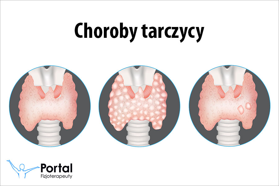 Choroby tarczycy