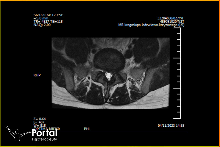 Wypadnięcie jądra miażdżystego