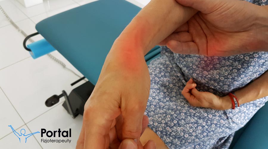 Choroba de Quervaine - objawy, leczenie