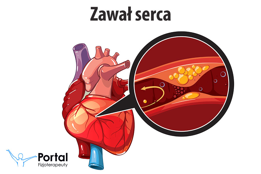 Zawał serca