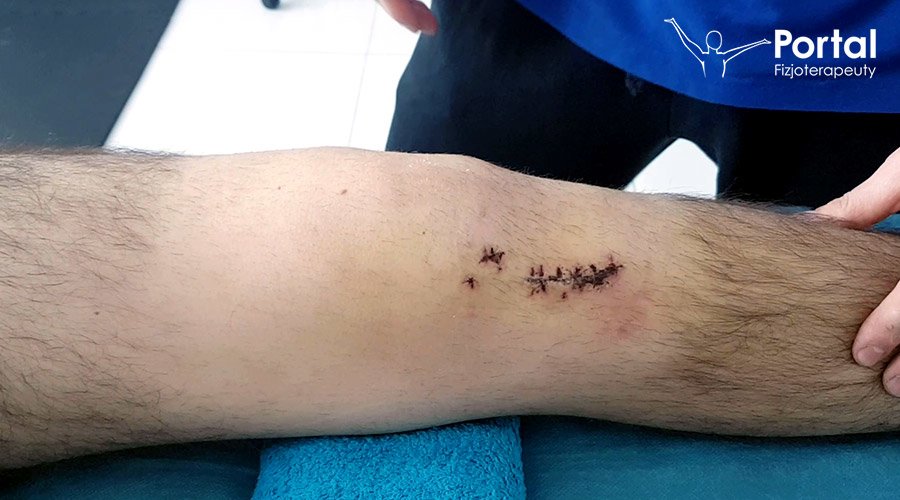 Ćwiczenia izometryczne