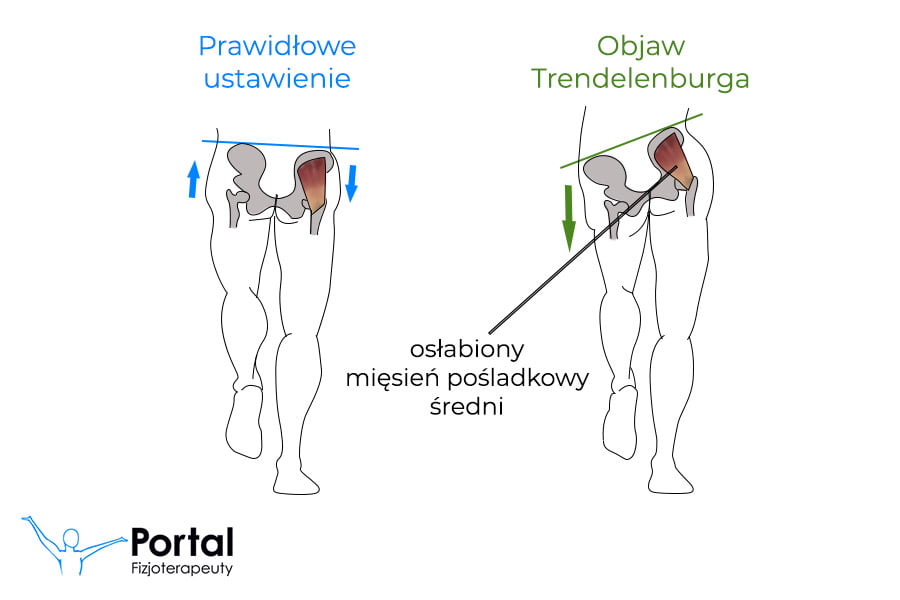 Objaw Trendelenburga