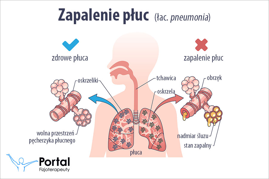Zapalenie płuc