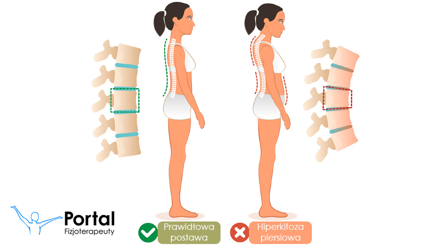 Hiperkifoza piersiowa