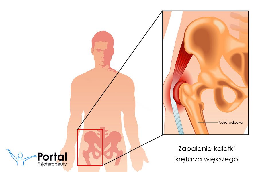 Zapalenie kaletki krętarza większego