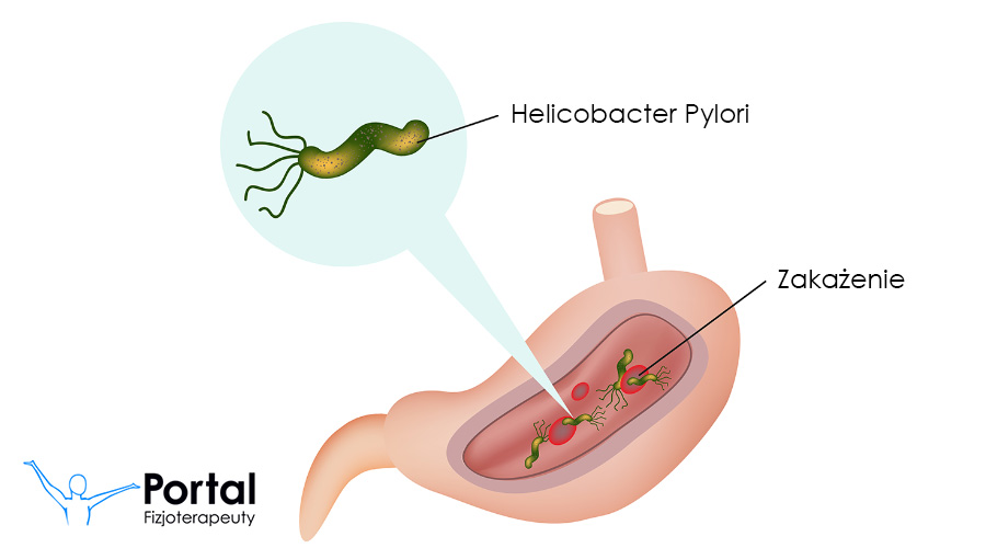 Zapalenie błony śluzowej żołądka