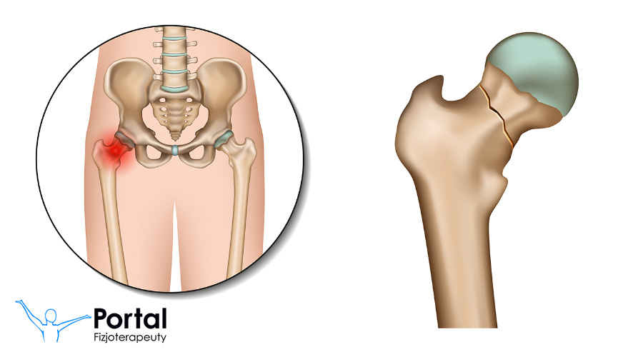 Złamanie szyjki kości udowej