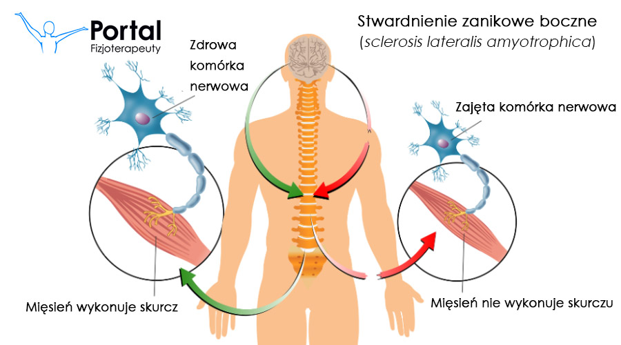 Stwardnienie zanikowe boczne