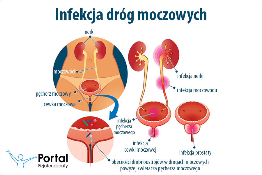 Infekcja dróg moczowych