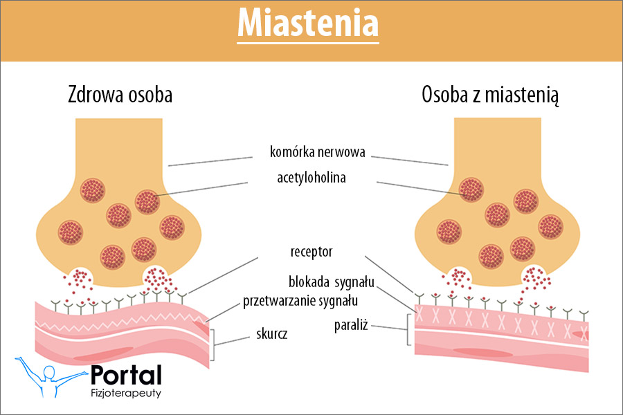 Miastenia