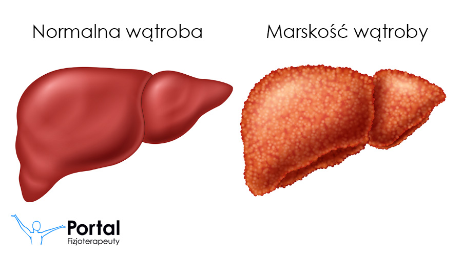 Marskość wątroby