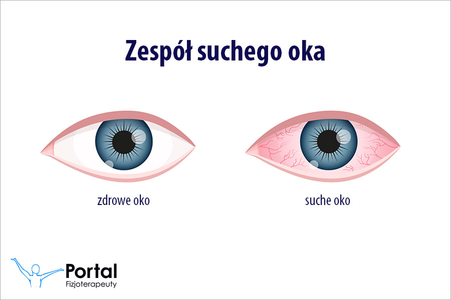Zespół suchego oka