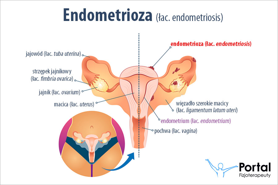 Endometrioza