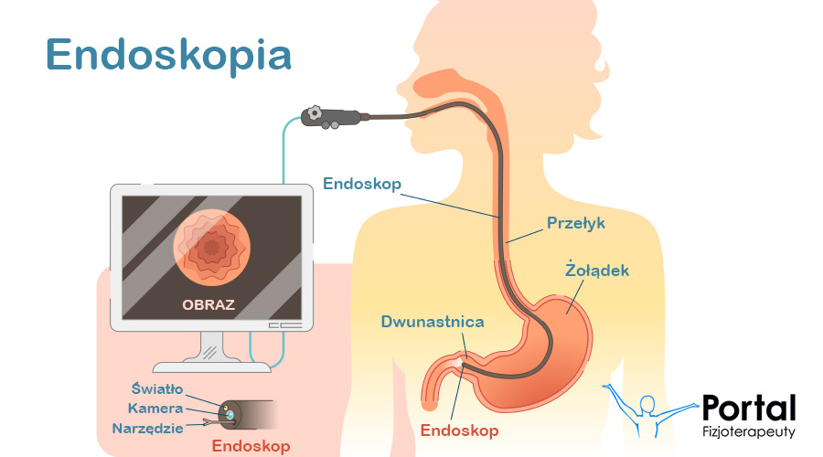 Endoskopia