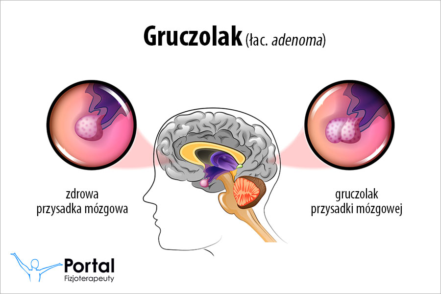 Gruczolak