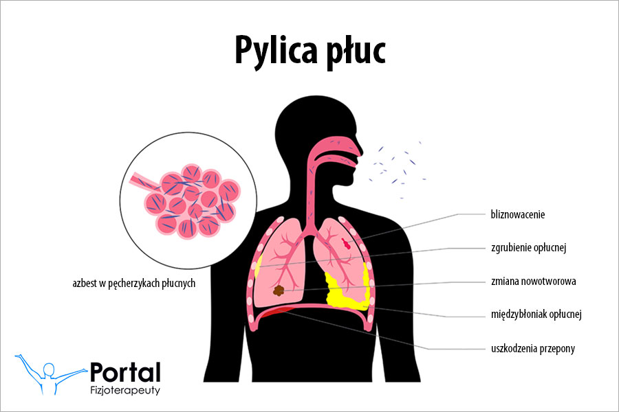 Pylica płuc