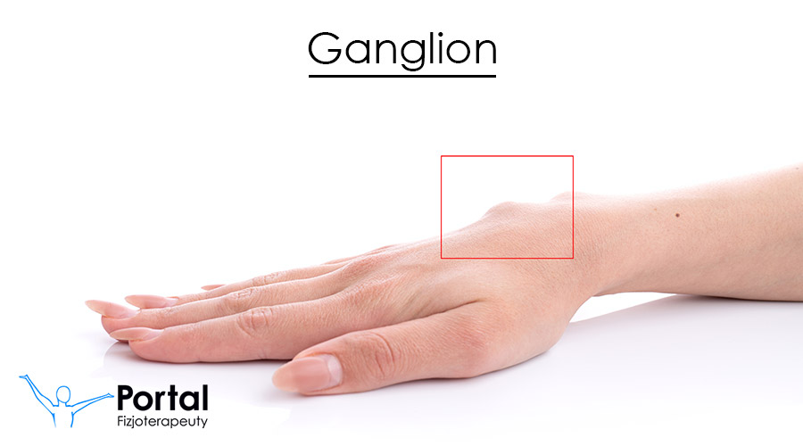 Ganglion