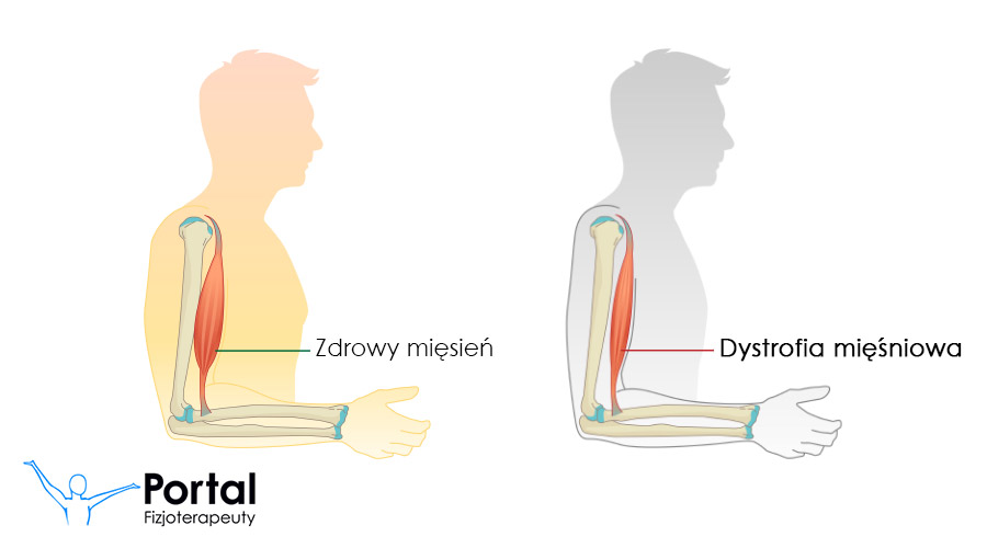 Dystrofia mięśniowa