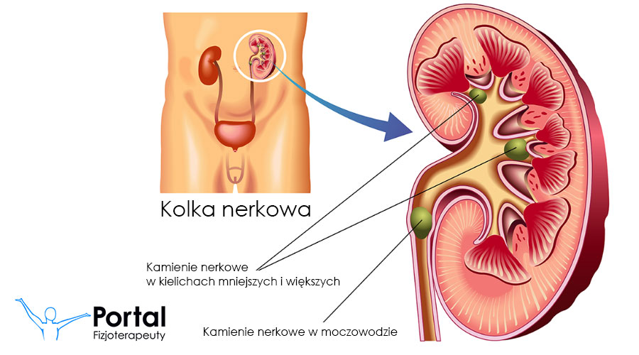 Kolka nerkowa