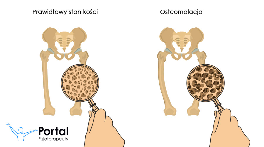 Osteomalacja