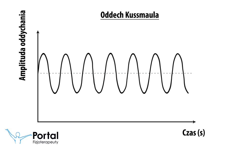 Oddech Kussmaula