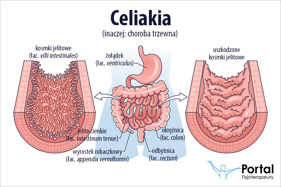 Celiakia
