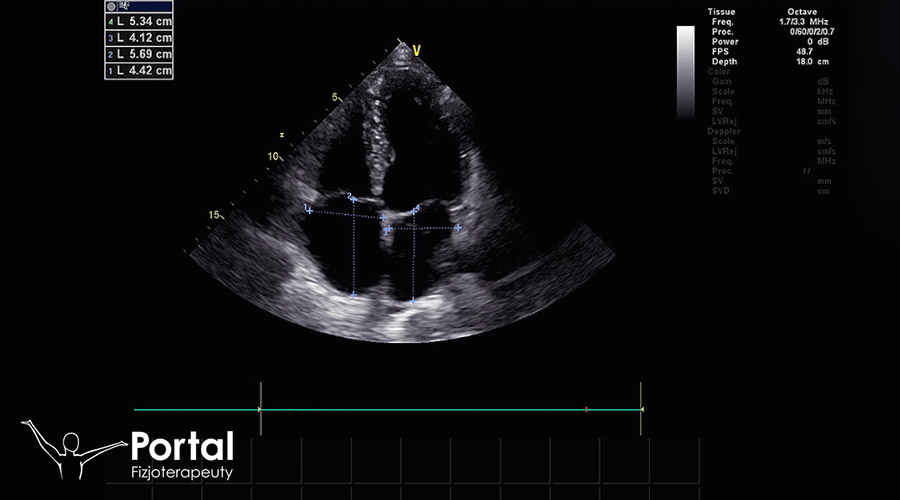 Badanie echokardiograficzne (echokardiografia)