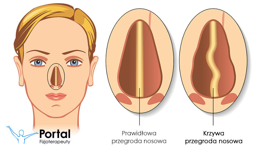 Krzywa przegroda nosowa