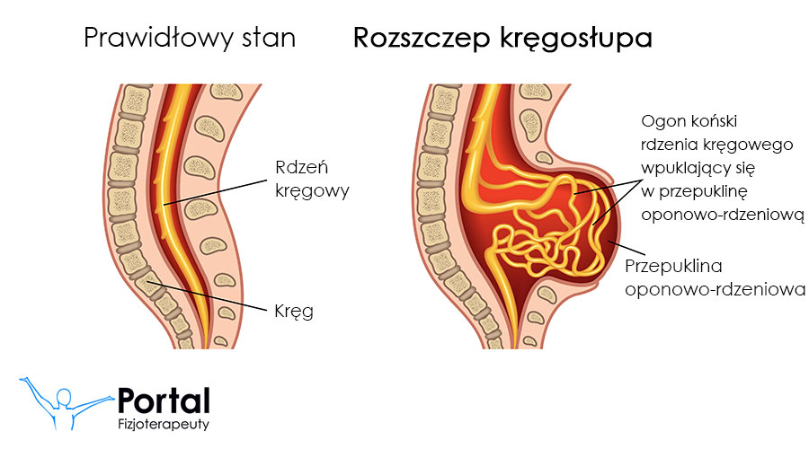 Rozszczep kręgosłupa