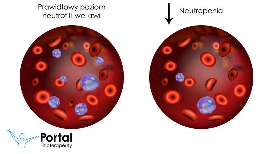Neutropenia