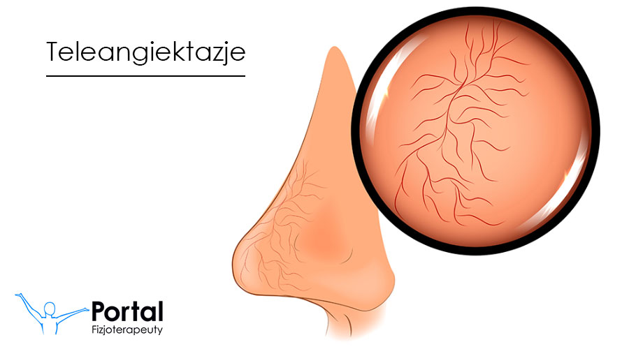 Teleangiektazje