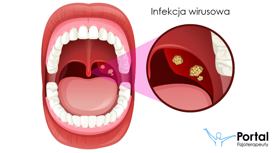 Angina infekcja wirusowa