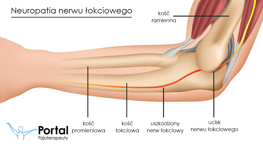 Mononeuropatia - neuropatia nerwu łokciowego