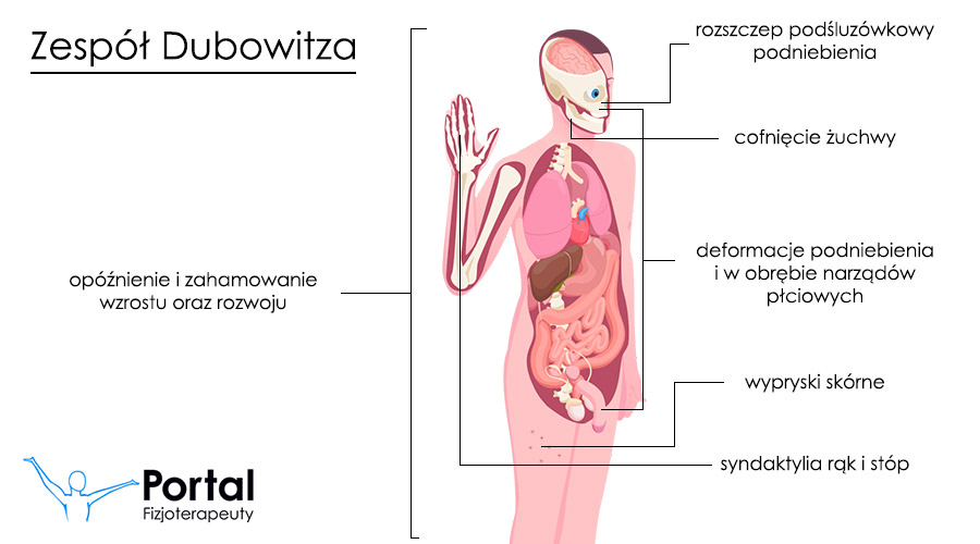 Zespół Dubowitza