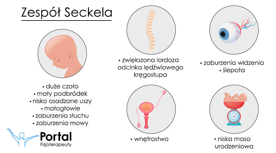Zespół Seckela